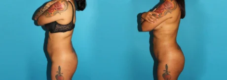 Brazilian Butt Lift case #4764