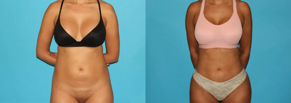 Brazilian Butt Lift case #4765