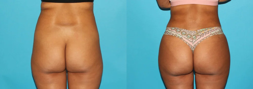 Brazilian Butt Lift case #4765