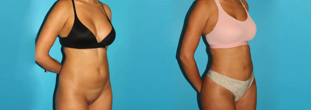 Brazilian Butt Lift case #4765