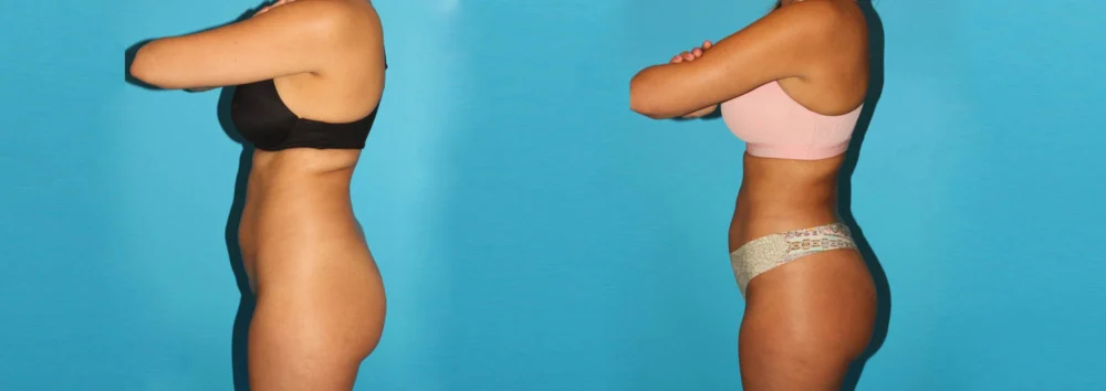 Brazilian Butt Lift case #4765