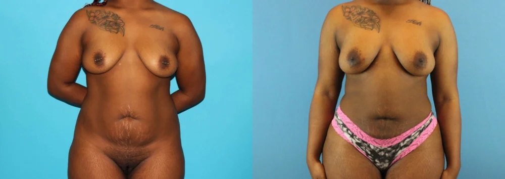 Brazilian Butt Lift case #4583