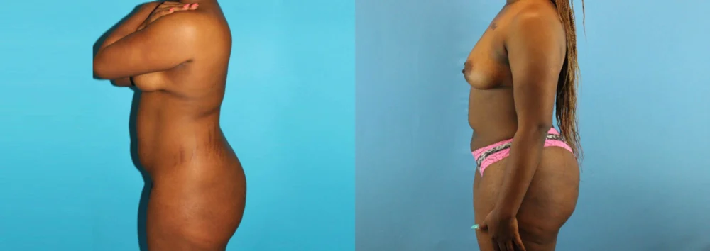 Brazilian Butt Lift case #4583