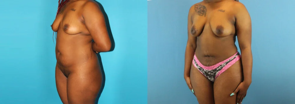 Brazilian Butt Lift case #4583