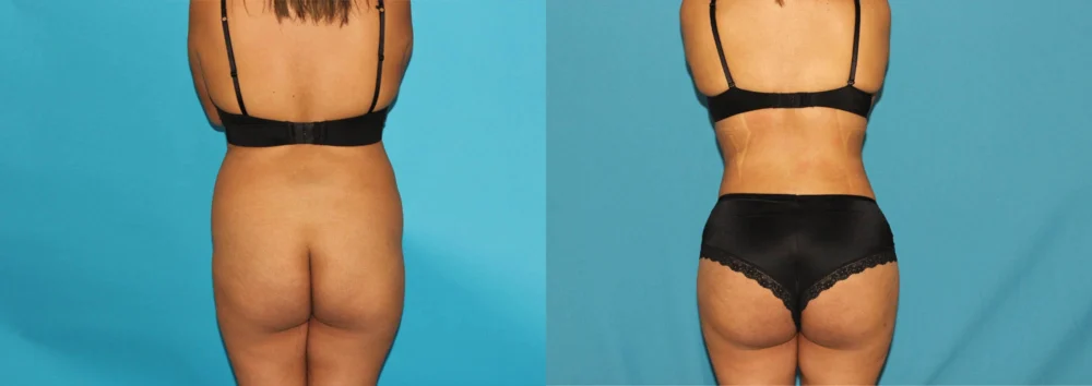 Brazilian Butt Lift case #4819