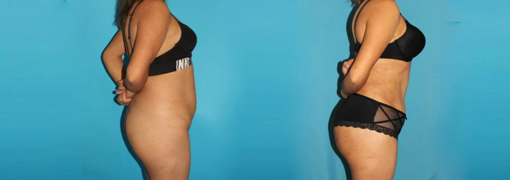 Brazilian Butt Lift case #4819