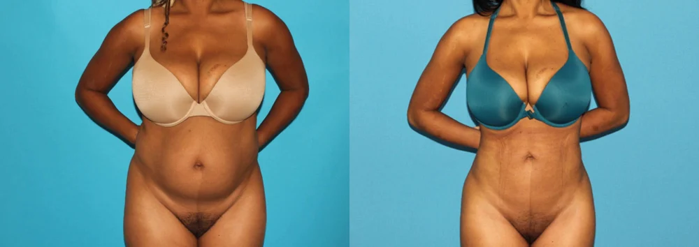 Brazilian Butt Lift case #4675