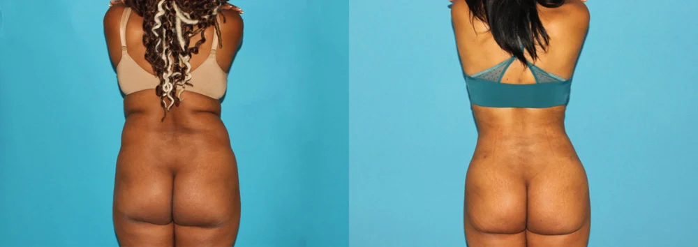 Brazilian Butt Lift case #4675