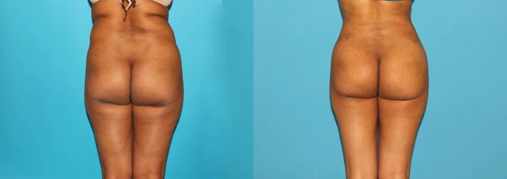 Brazilian Butt Lift case #4675