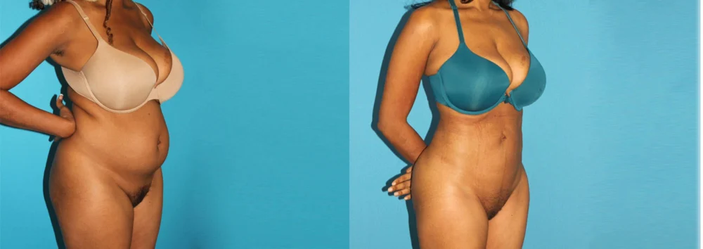 Brazilian Butt Lift case #4675