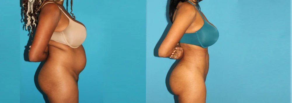 Brazilian Butt Lift case #4675