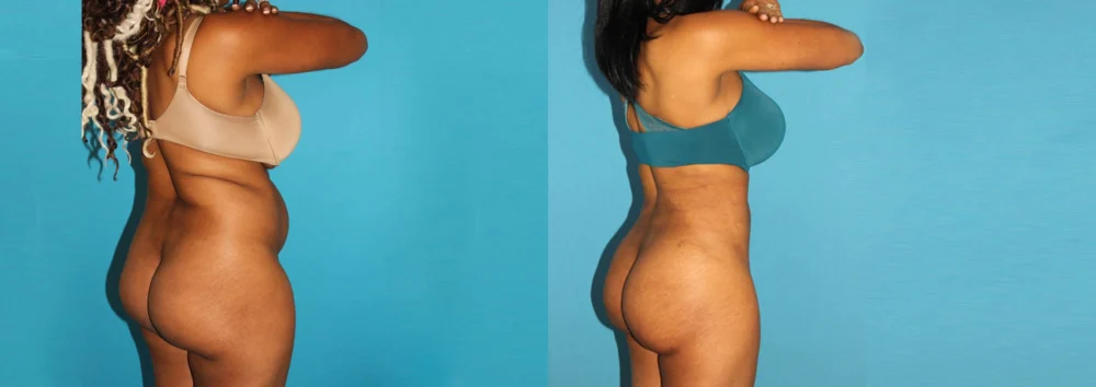 Brazilian Butt Lift case #4675