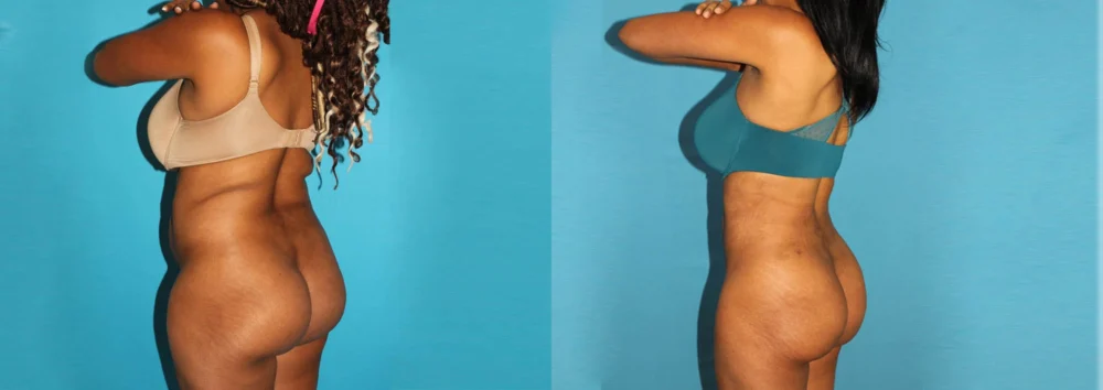 Brazilian Butt Lift case #4675