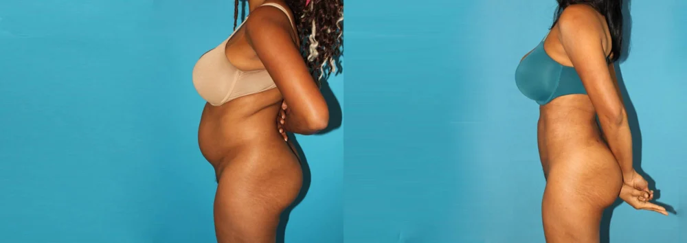 Brazilian Butt Lift case #4675