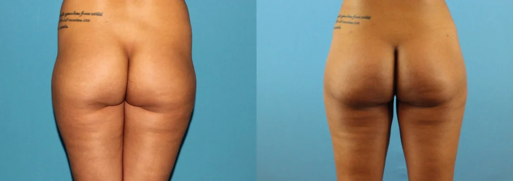 Brazilian Butt Lift case #4820