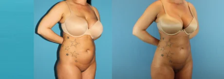 Brazilian Butt Lift case #4820