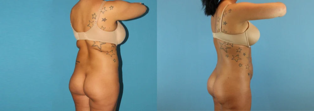 Brazilian Butt Lift case #4820