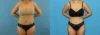 Brazilian Butt Lift case #4881 slider thumbnail