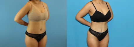 Brazilian Butt Lift case #4881