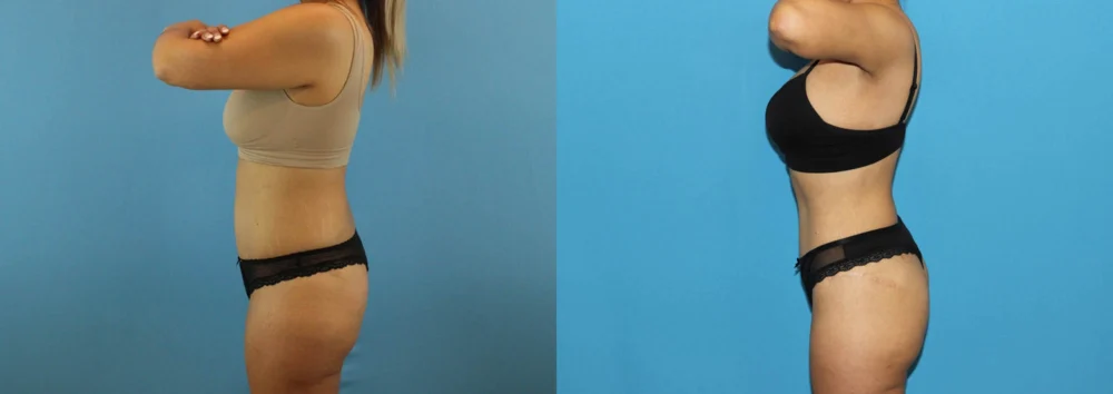 Brazilian Butt Lift case #4881