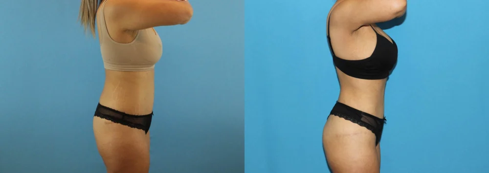 Brazilian Butt Lift case #4881