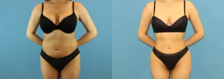 Brazilian Butt Lift case #4903