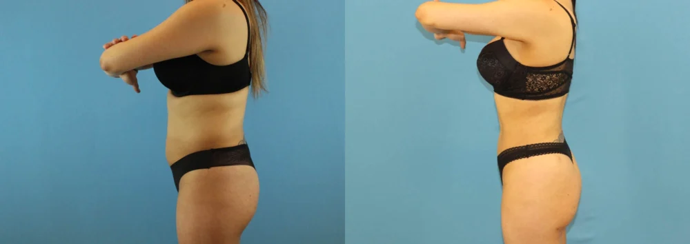 Brazilian Butt Lift case #4903