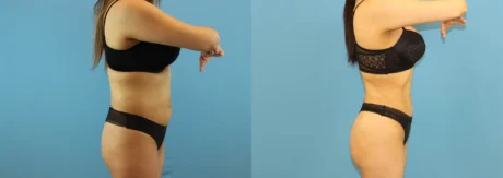 Brazilian Butt Lift case #4903