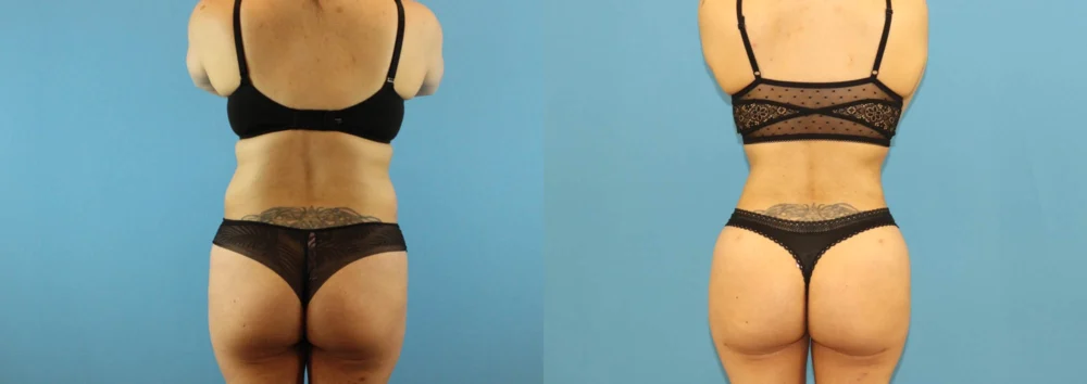 Brazilian Butt Lift case #4903