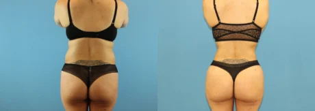 Brazilian Butt Lift case #4903