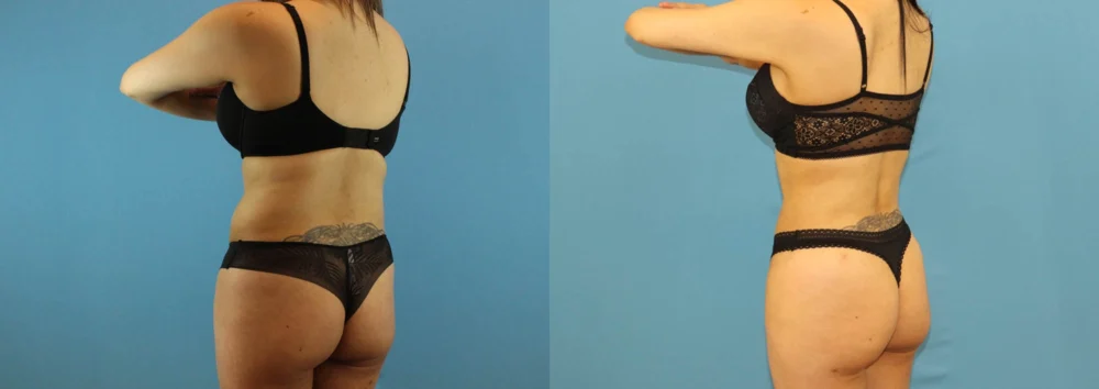 Brazilian Butt Lift case #4903