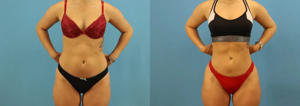 Brazilian Butt Lift case #4963