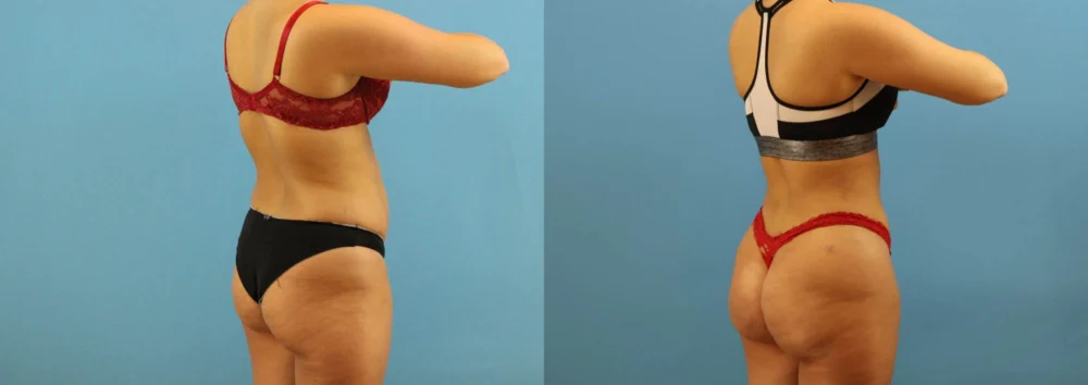 Brazilian Butt Lift case #4963