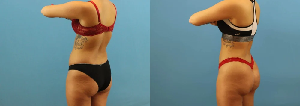 Brazilian Butt Lift case #4963