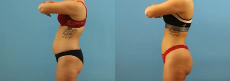 Brazilian Butt Lift case #4963