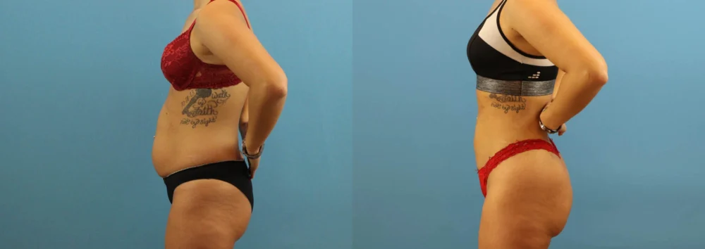 Brazilian Butt Lift case #4963