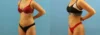 Brazilian Butt Lift case #4963 slider thumbnail