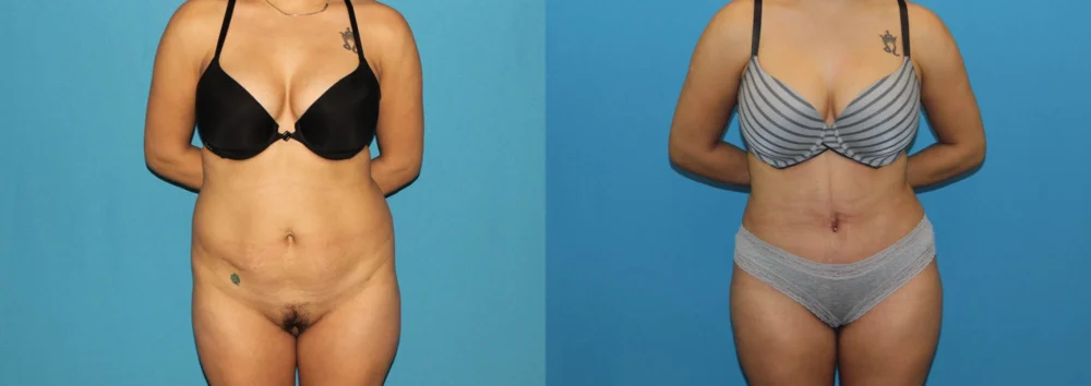 Brazilian Butt Lift case #4965