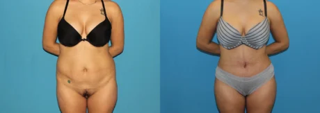 Brazilian Butt Lift case #4965