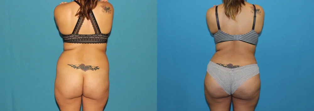 Brazilian Butt Lift case #4965