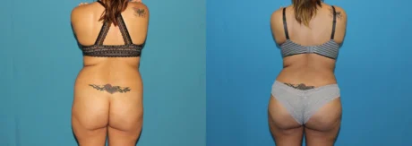 Brazilian Butt Lift case #4965