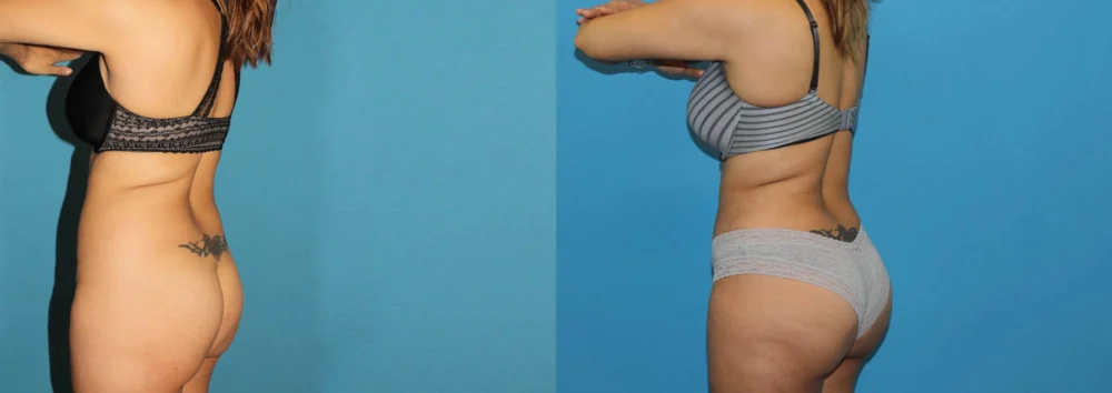 Brazilian Butt Lift case #4965