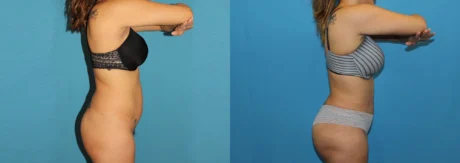 Brazilian Butt Lift case #4965