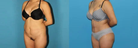 Brazilian Butt Lift case #4965