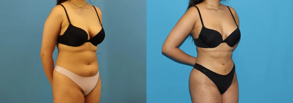 Brazilian Butt Lift case #4966