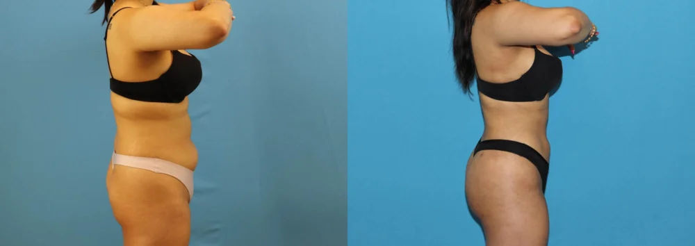 Brazilian Butt Lift case #4966