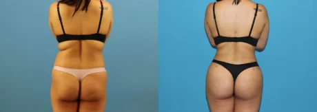 Brazilian Butt Lift case #4966