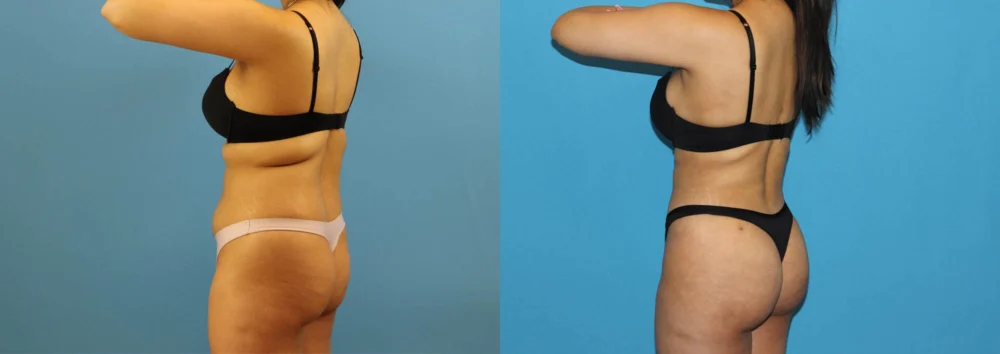 Brazilian Butt Lift case #4966