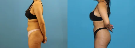 Brazilian Butt Lift case #4966