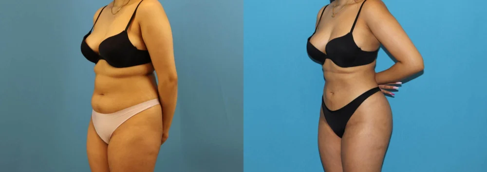 Brazilian Butt Lift case #4966